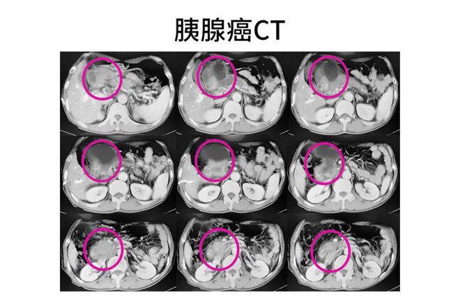 胰腺肿瘤最新研究进展与前沿治疗策略探讨